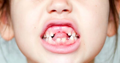Răng em bé bắt đầu mọc từ tuổi nào?
